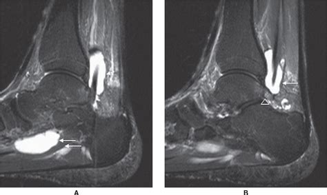 Anterior Tibial Tendon Mri