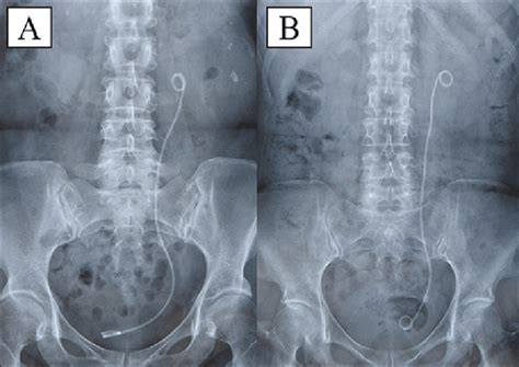 Classification Of The Intravesical Ureteral Stent Position A