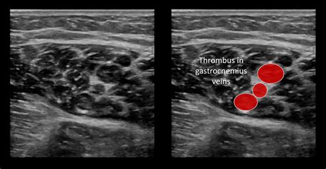 Ultrasound Case 095 • LITFL • POCUS Self-Assessment Quiz