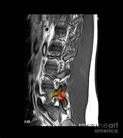 Mri Of L5 Spondylolysis Photograph By Living Art Enterprises Pixels