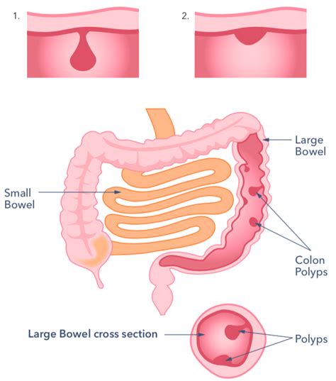 Polyps In The Bowel Guts Uk