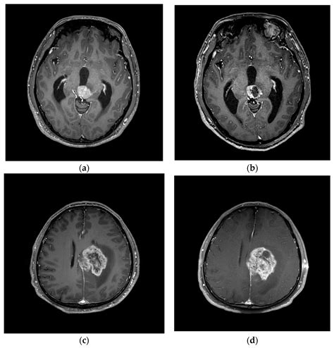 Jpm Free Full Text Navigation Guided Biopsy Is As Effective As Frame Based Stereotactic Biopsy