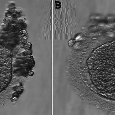 A Oocyte In Metaphase II B Oocyte MII Fertilized With 04 Pronuclei