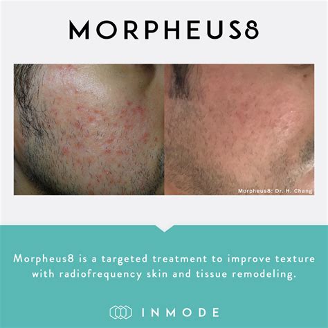 Skin Tightening And Texture Treatment Morpheus8 At The Hogarth