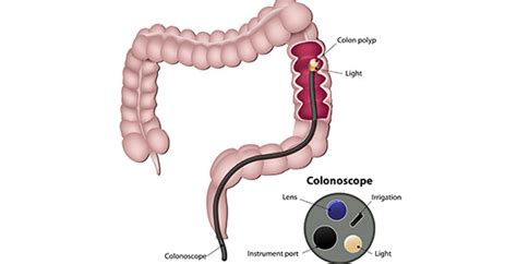 COLONOSCOPY IN IBD Nutrition 4 IBD