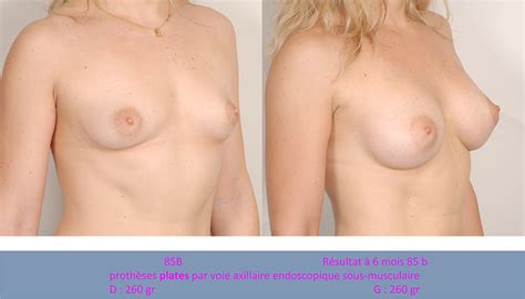 Clinique Del Mar Augmentation Mammaire