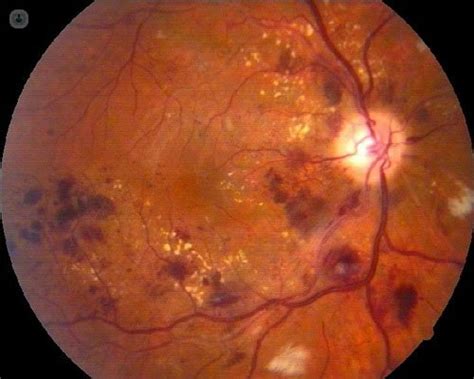 Cl Nica De Ojos Oftalmic L Ser Preguntas Clave Sobre La Retinopat A