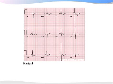 Ecgpedia Ecg Course Part I Basic Electrocardiography Ppt Free Download