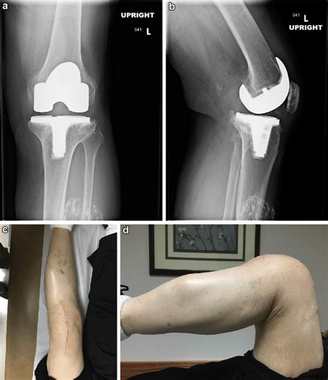 Anteroposterior A And Lateral B Views At 1 Year Postoperatively Download Scientific