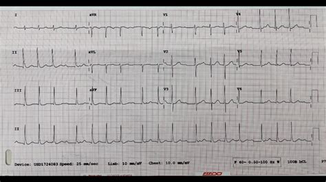 Is this EKG normal? : EKGs