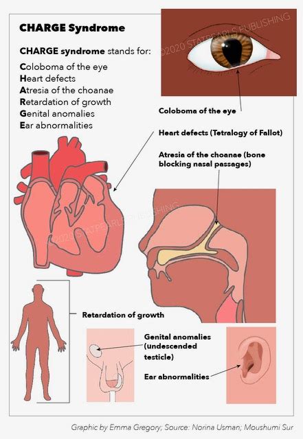 Charge Syndrome Article