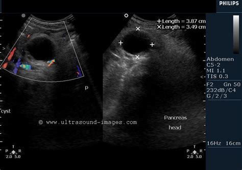 Pancreatic Pseudocyst Ultrasound