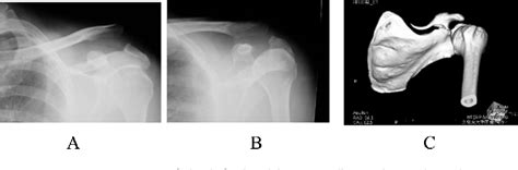 Figure 1 From A Case Of Acromioclavicular Joint Dislocation Associated With Coracoid Process