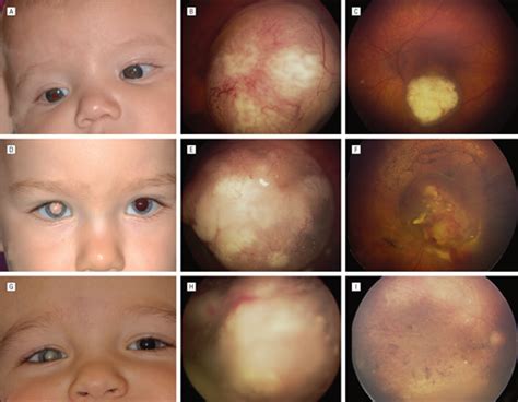 Intra Arterial Chemotherapy For Retinoblastoma Report No 1 Control Of Retinal Tumors