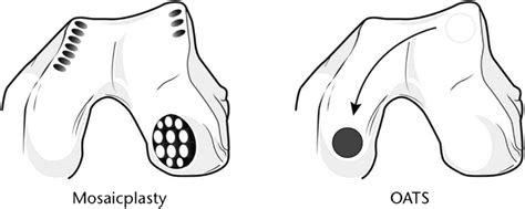 Illustration Comparing Oats And Mosaicplasty Procedures Download Scientific Diagram