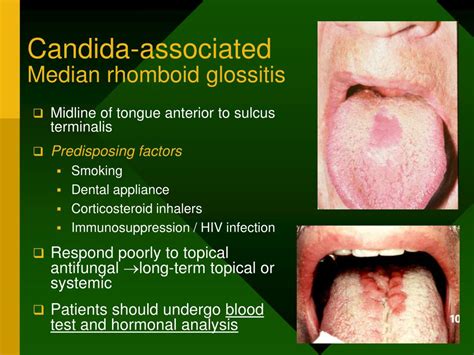 Ppt Fungal Infection Candidadiasis Candidosis Powerpoint