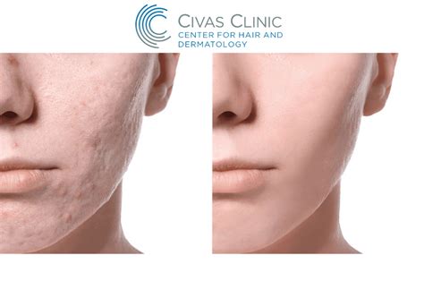 Sivilce Akne İzi Tedavisi Ankara Dr Ekrem Civas Dermatoloji