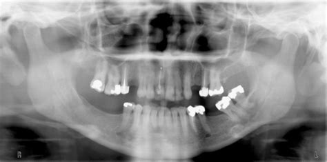 Mental Foramen – Dr. G's Toothpix