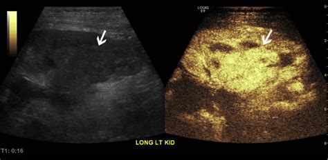 Contrast Enhanced Ultrasound Detects Recurrent Renal Cell Carcinoma In