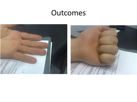 Flexor tendon surgery | PDF