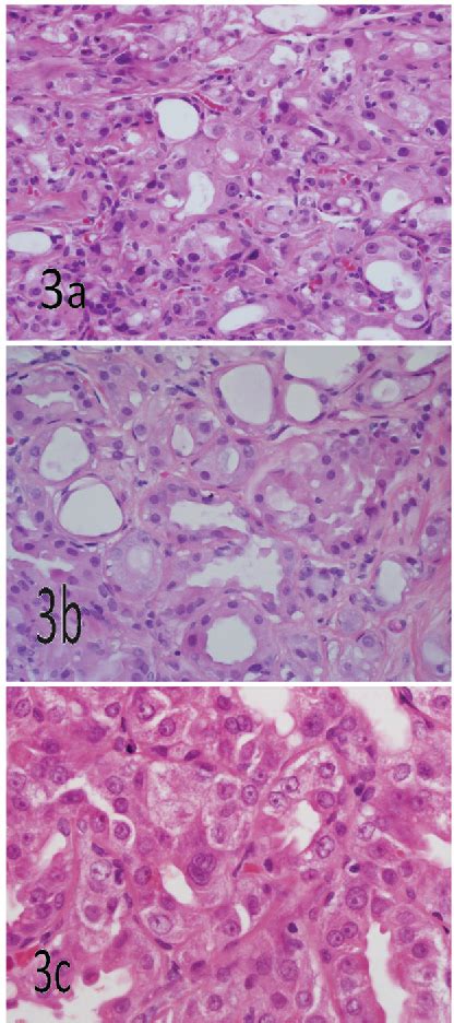 Breast Apocrine Adenosis Semantic Scholar