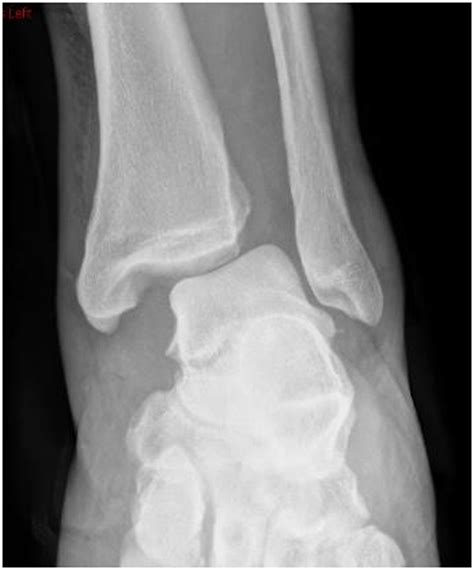 Subluxation Of The Posterior Tibial Tendon Into The Tibiofibular Syndesmosis Secondary To High