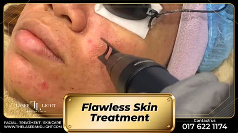 Flawless Skin Treatment Laser Light Skin Centre YouTube