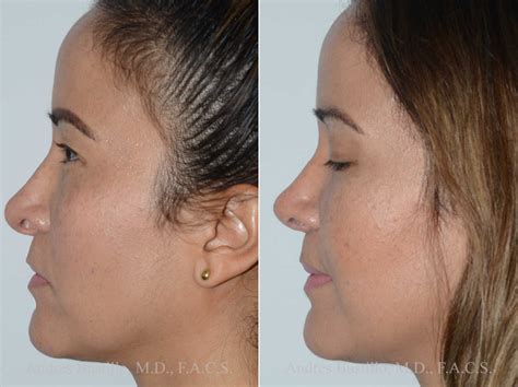 Revision Rhinoplasty Miami Perfect Your Nose With Dr Bustillo