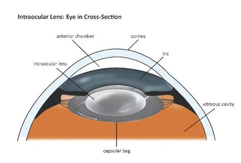 Description Of Cataract Surgery Cataract Surgery Information