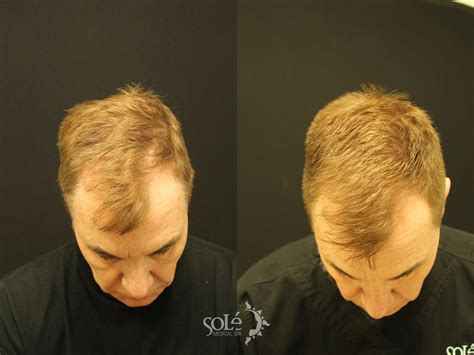 Prp Hair Loss Therapy Before And After Pictures Case 76 Tifton