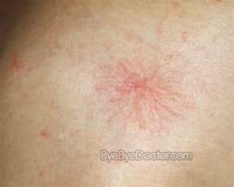 spider angioma treatment - pictures, photos