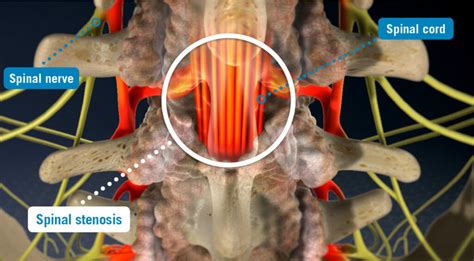 Understanding Spinal Stenosis Types Symptoms Dr Shardul Soman Dr