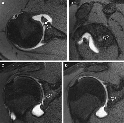 The Current State Of Imaging The Articular Cartilage Of The Upper