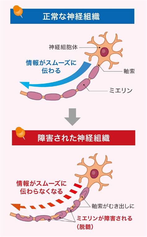 多発性硬化症の原因～症状～治療～リハビリ・全知識