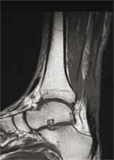 Tendinopathie et rupture du tendon dAchille évaluation radiologique