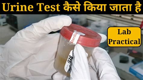 Urine Test Kaise Kiya Jata Hai Urine R M Routine And Microscopy