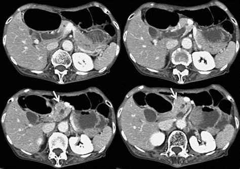 Ct Scan Of The Abdomen Showing A Duodenal Giant Mass Spreading From The