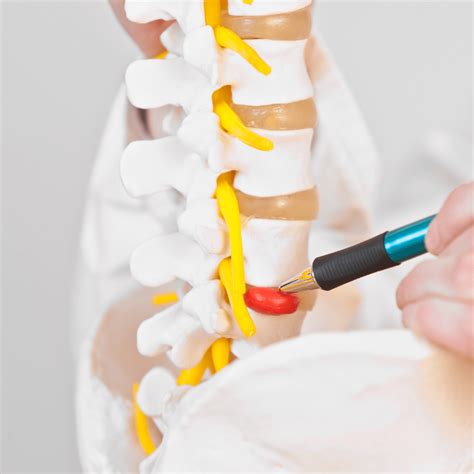 What You Should Know About Herniated Discs Colorado Spine And Scoliosis