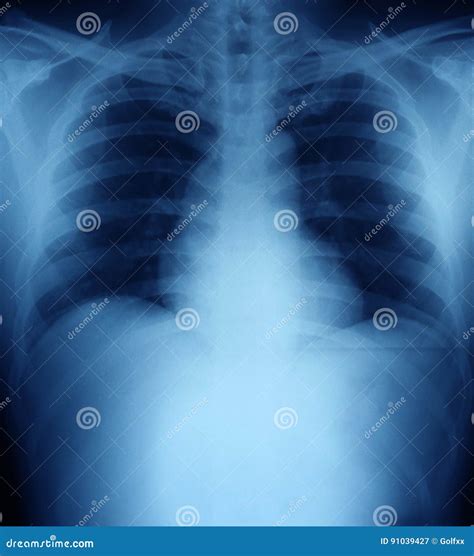 Xray of a human thorax stock image. Image of care, clinical - 91039427