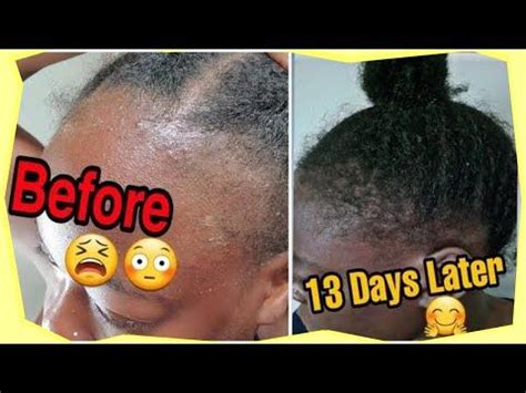 Grow Your Edges Back Super Fast Grow Natural Hair In Weeks Real