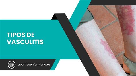 Tipos de vasculitis Apuntes enfermería