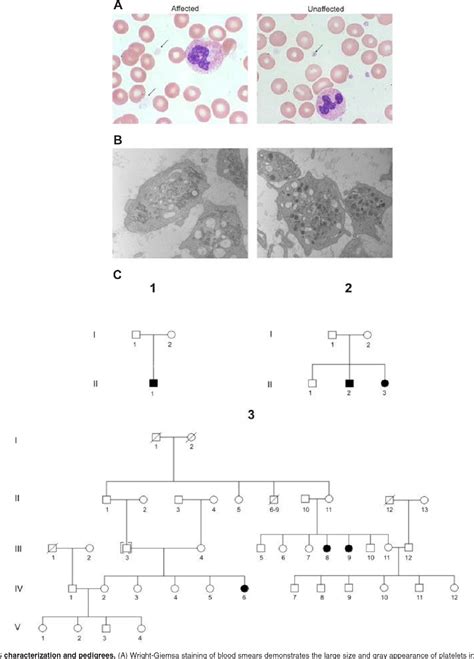 Figure 1 From Homozygosity Mapping With Snp Arrays Confirms 3p21 As A