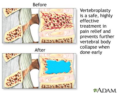 HIE Multimedia - Vertebroplasty