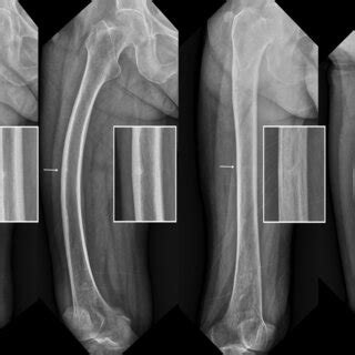 Radiographs Of Patient 2 At Last Followup Radiography Performed