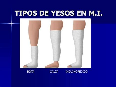 Tipos De Yesos En M I Elsa Mia Udocz