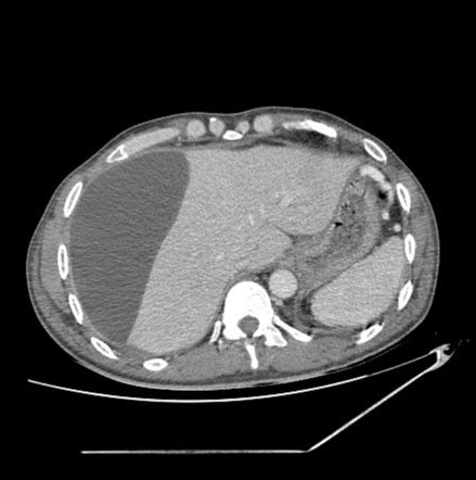 Hepatic Subcapsular Pseudocyst Radiology Case Radiopaedia Org