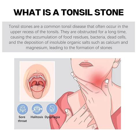 Tonsil Stone Remover Vacuum Kit - Gentle & Effective Oral Care Mouth Cleaner for Adults (2 ...