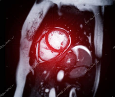 Las Im Genes De Resonancia Magn Tica Cardiaca Son Fundamentales Para