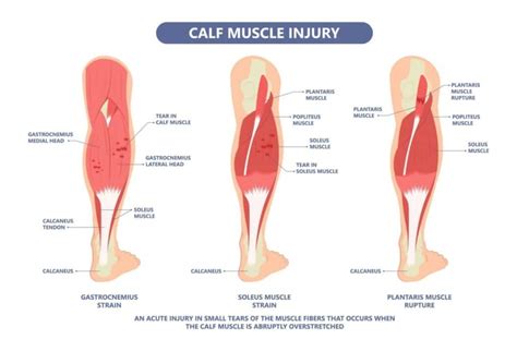 Tight Calves Running Main Causes Explained