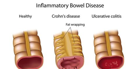 Inflammatory Bowel Disease | Prevention